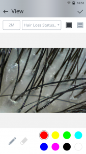scalp analysis device