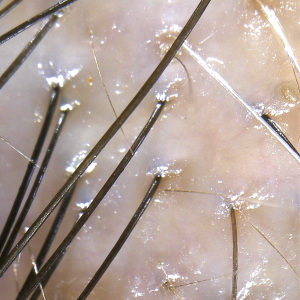 hair density analysis