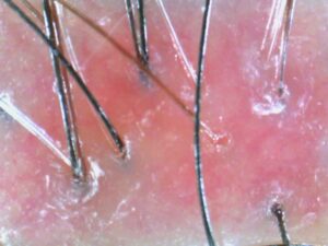 customized scalp care