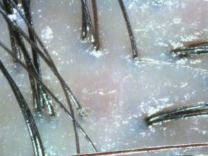 customized scalp care