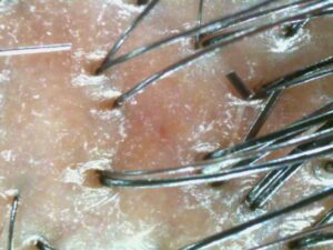 customized scalp care