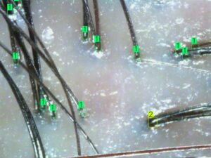 ai scalp grader