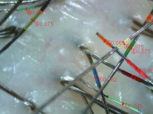 ai scalp grader