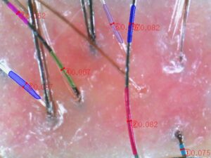 ai scalp grader