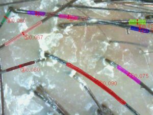 ai scalp grader