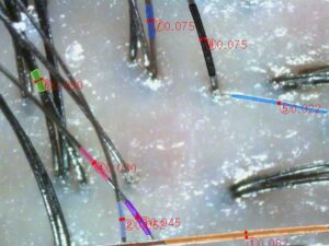 ai scalp grader