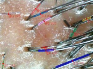 ai scalp grader