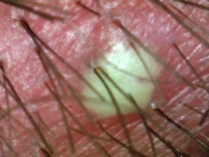 hair density analysis