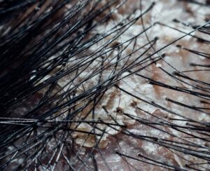 hair density analysis