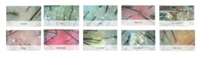 10 scalp type analysis
