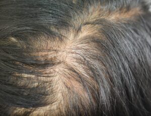 hair density analysis
